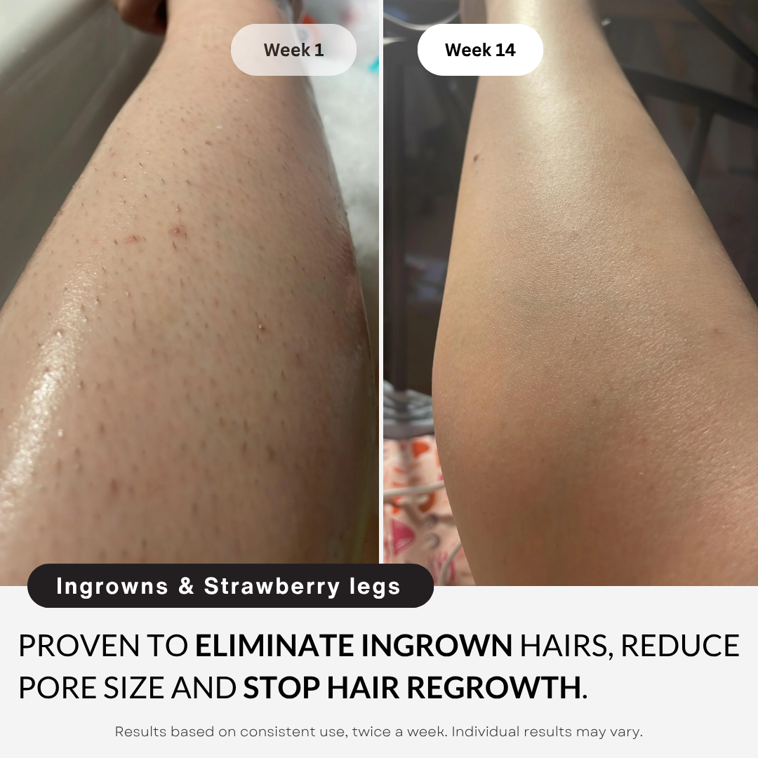 My Smooth Skin Pro™