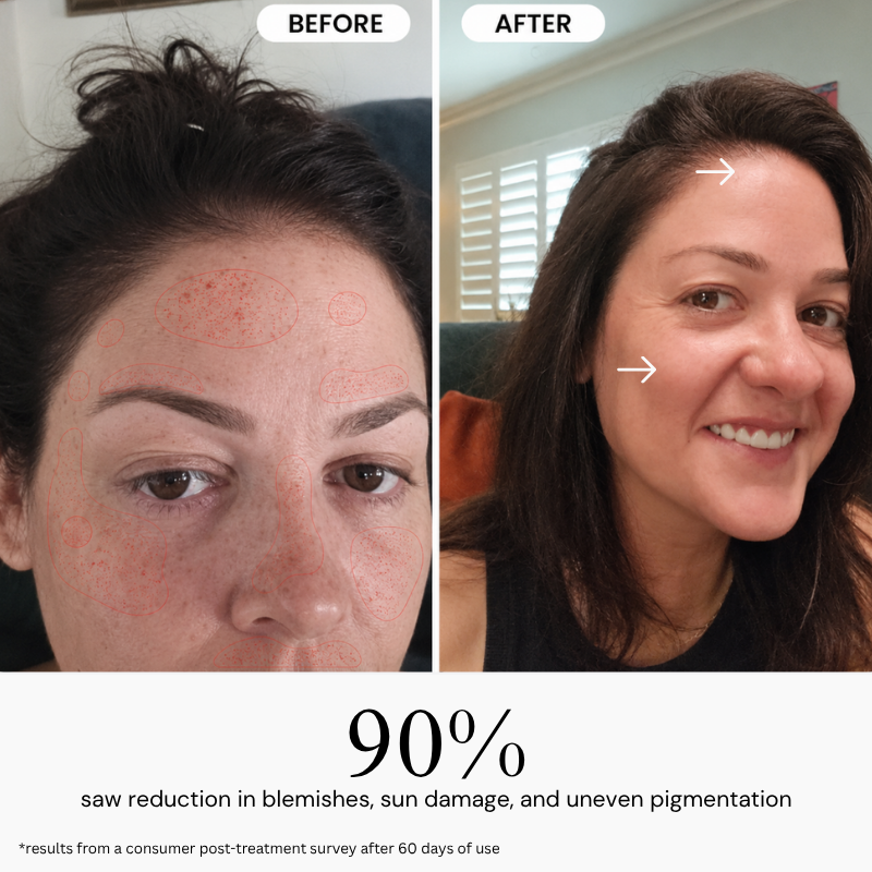 My Smooth Skin LumiPore 5-in-1 Skin Booster