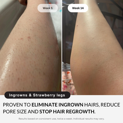 My Smooth Skin Pro™