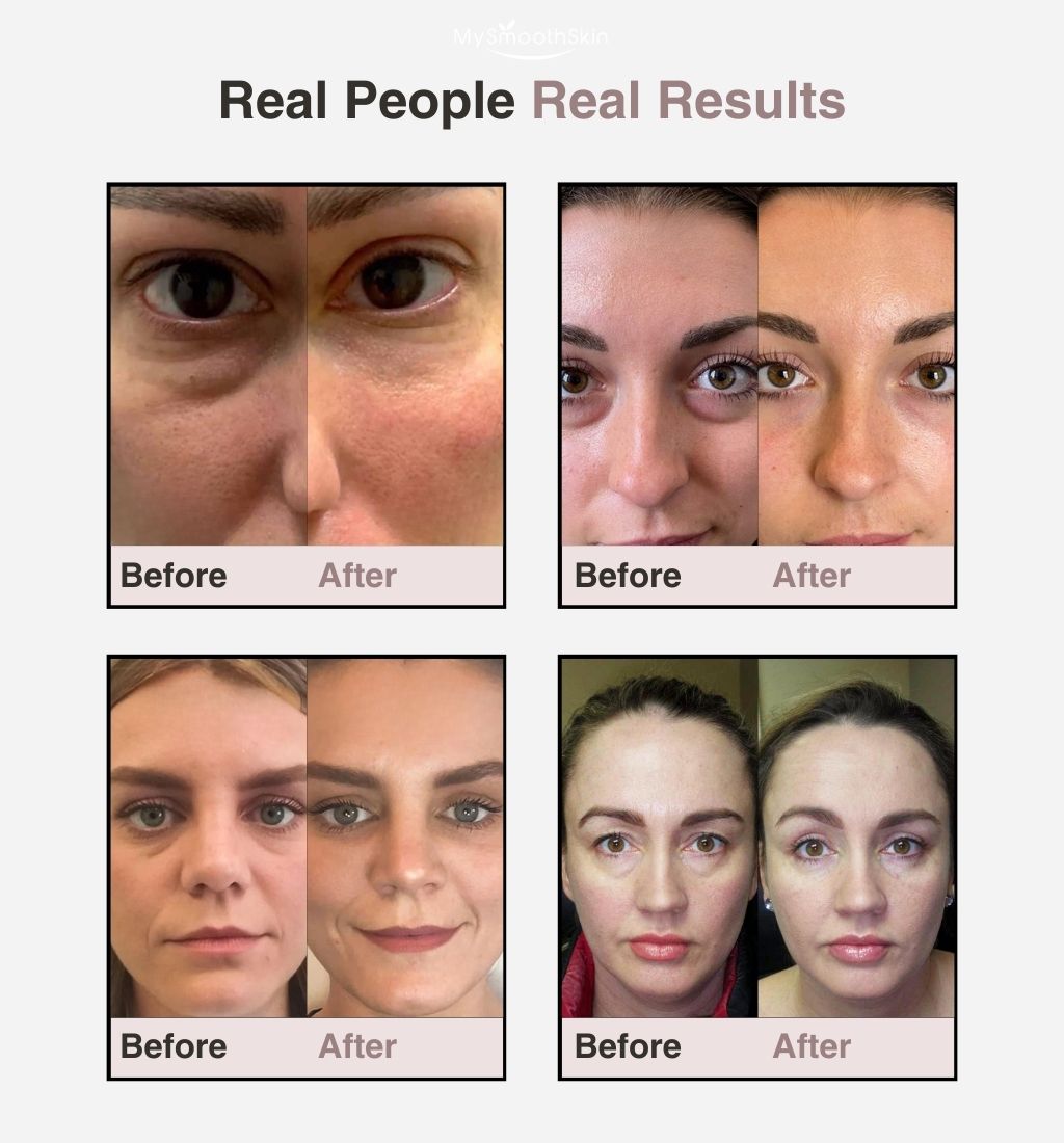 My Smooth Skin EyePods™